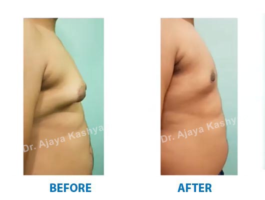 enlarged male breast treatment in delhi
