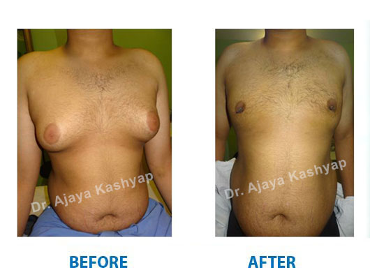 male chest surgery