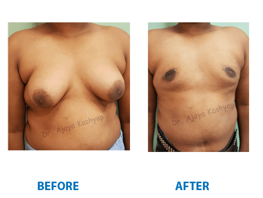 Male Breast (Gynecomastia) surgery in delhi
