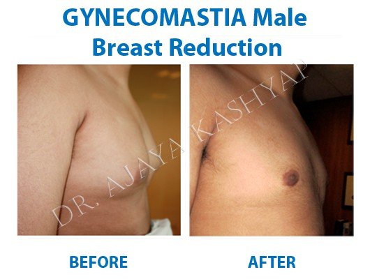 gynecomastia surgery review